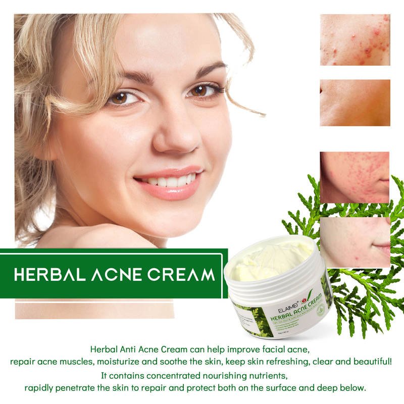 Natural Herbal Acne Cream for face and blemish-prone skin care